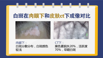 小宝脸上皮肤有淡淡的白斑